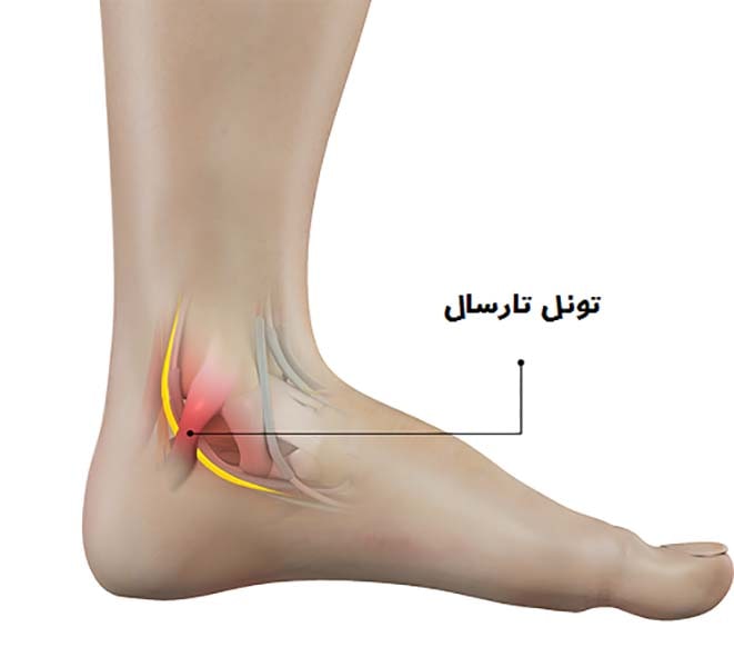 دلایل درد پا سندروم تونل تارسال یا گیر افتادن عصب