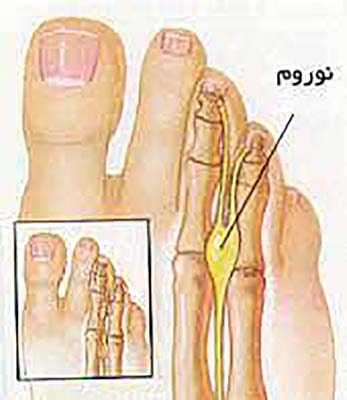 دلایل درد پا تومور عصب (نوروما) مورتون