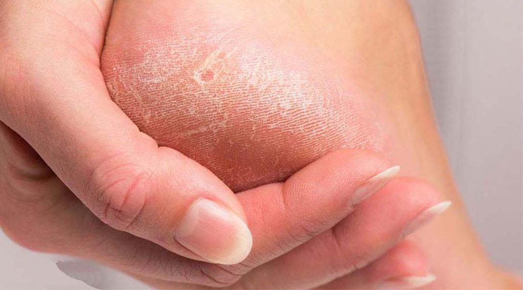 پینه پا چیست؟- علل و عوامل