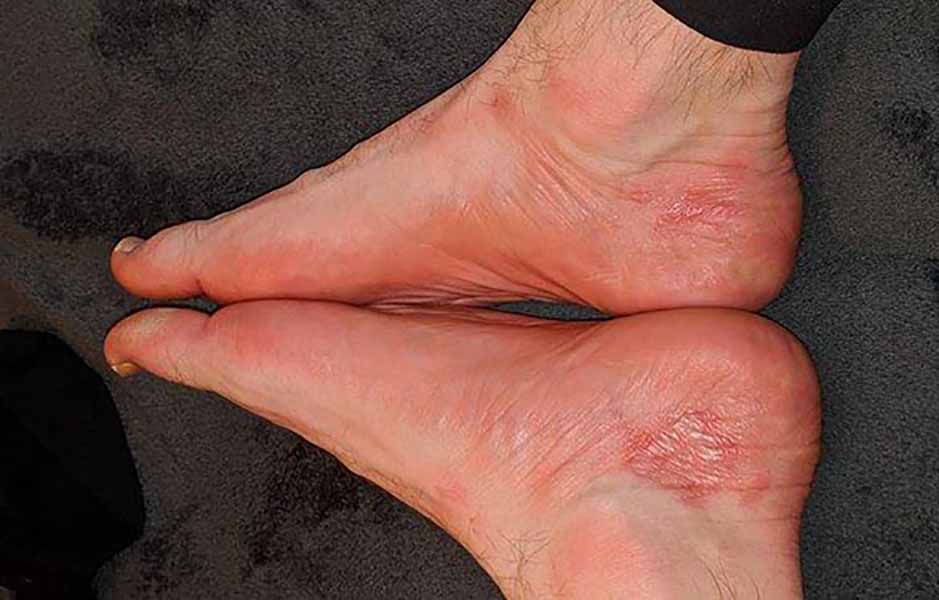 اگزمای تماسی آلرژیک پا