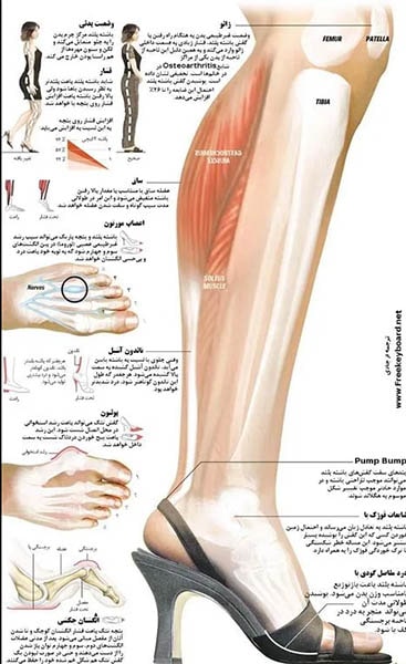 کوتاه شدن تاندون آشیل