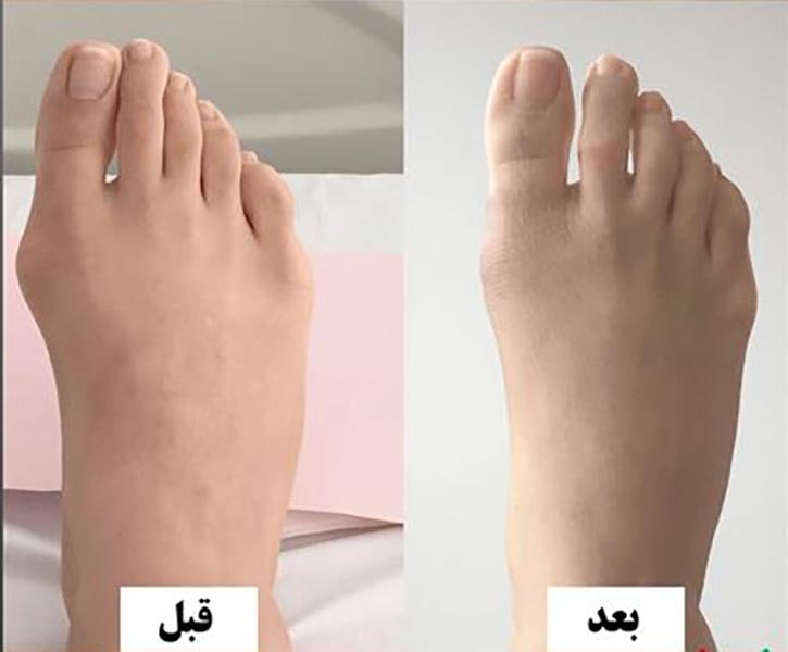 بیماری هالوکس والگوس - درمان با جراحی